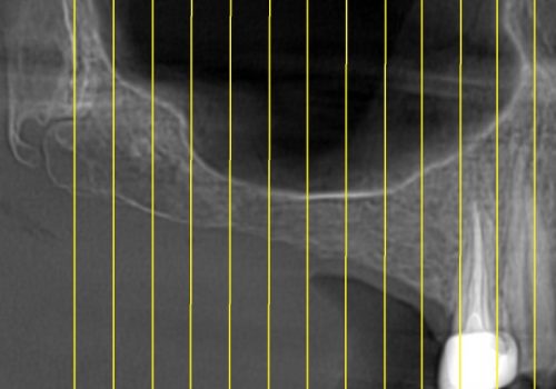 CBCT